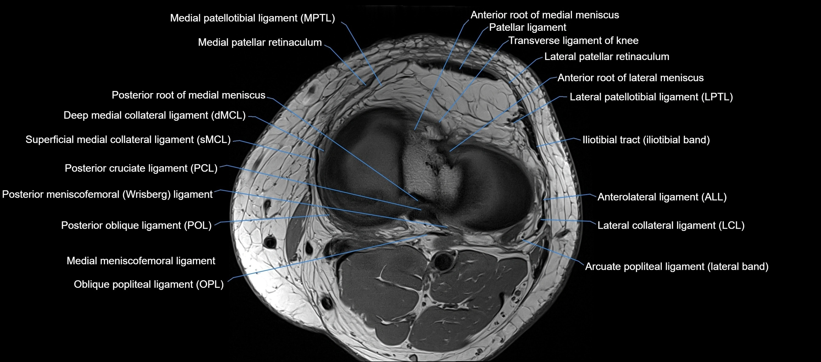 MRI Knee axial  ligaments cross sectional anatomy 3T  radiology  image-img-03001-00030.webp